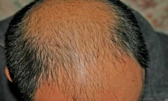 Hair Loss Causes | Male Pattern Baldness - Hasson &amp; Wong